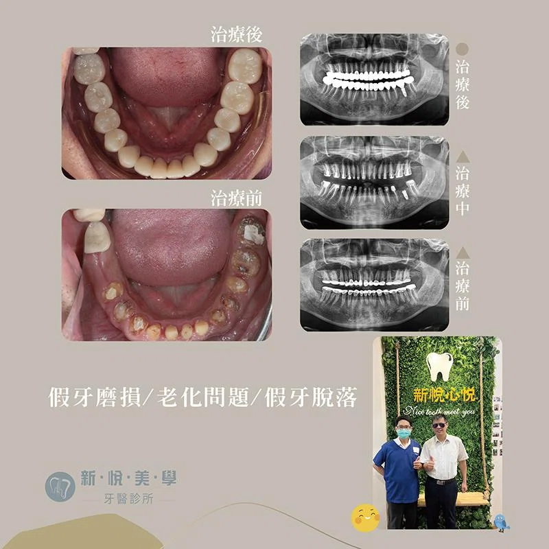 全口重建治療：李先生重拾自信笑容，告別假牙脫落困擾