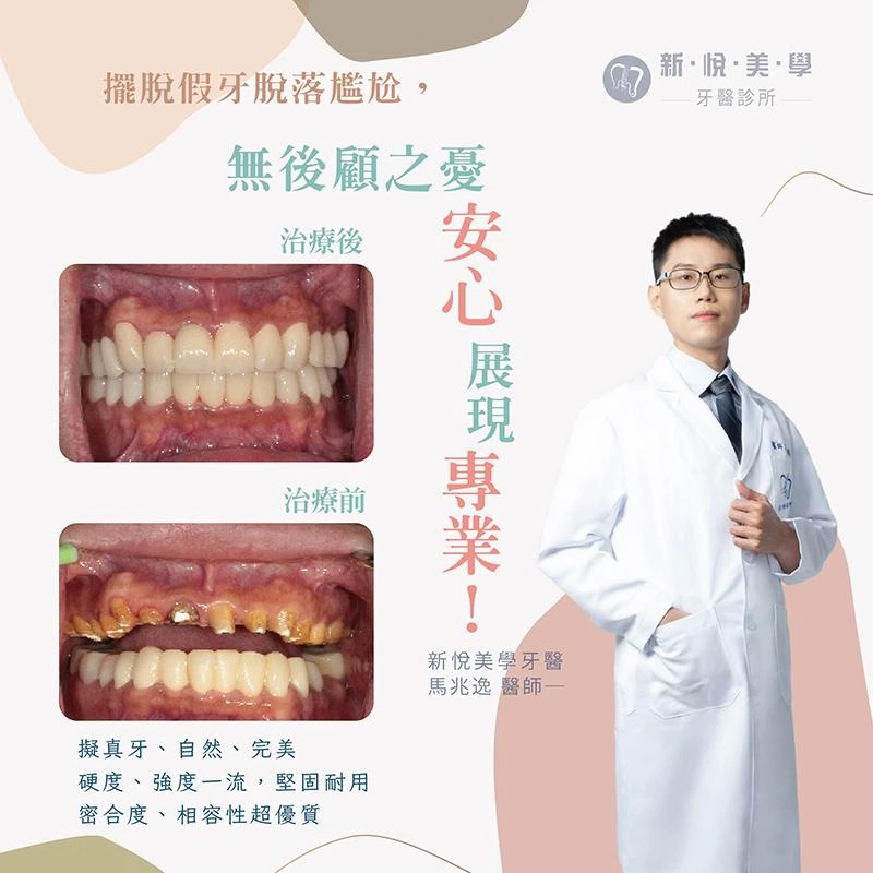 全口重建治療：李先生重拾自信笑容，告別假牙脫落困擾