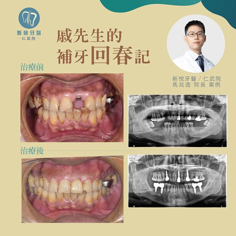 戚先生的「缺牙逆轉術」：7 顆牙齒補回青春
