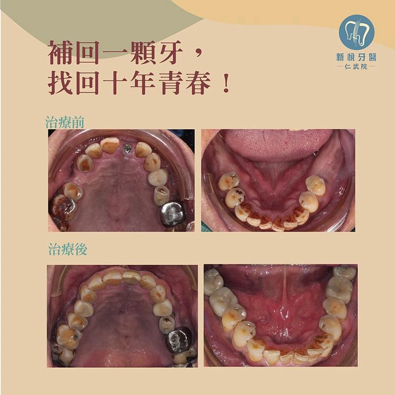 戚先生的「缺牙逆轉術」:7 顆牙齒補回青春 戚先生的「缺牙逆轉術」:7 顆牙齒補回青春