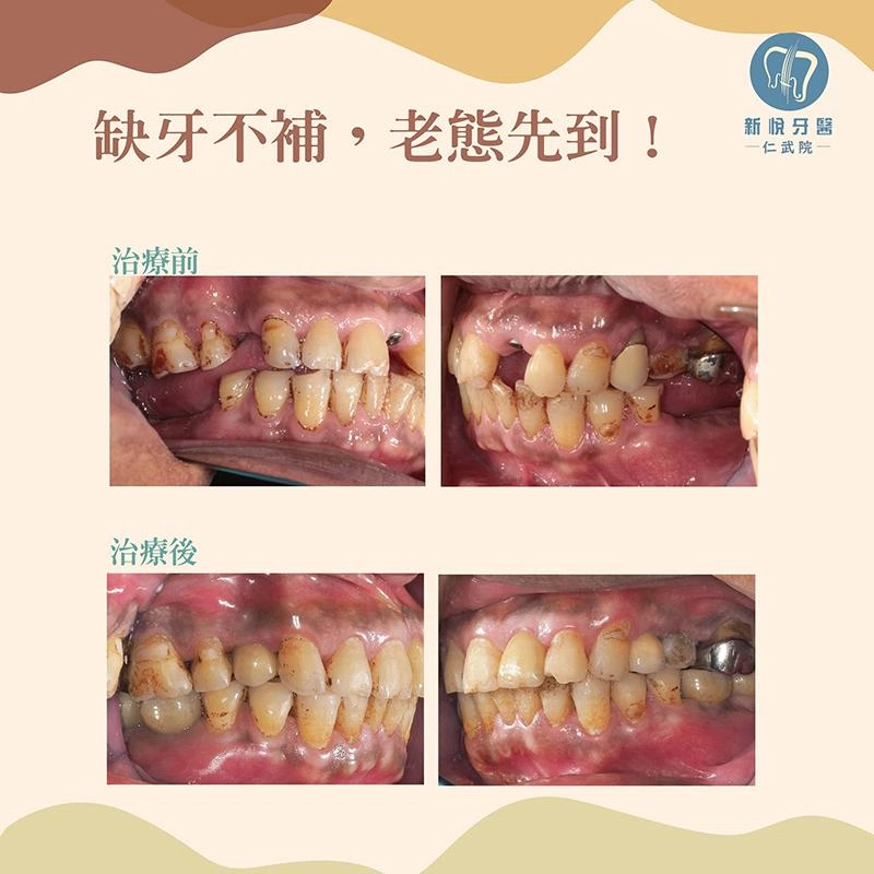 戚先生的「缺牙逆轉術」:7 顆牙齒補回青春 戚先生的「缺牙逆轉術」:7 顆牙齒補回青春