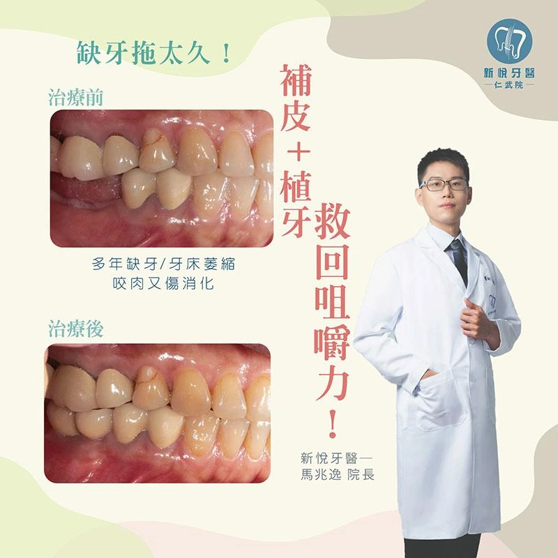 缺牙拖太久，補皮+植牙救回咀嚼力！