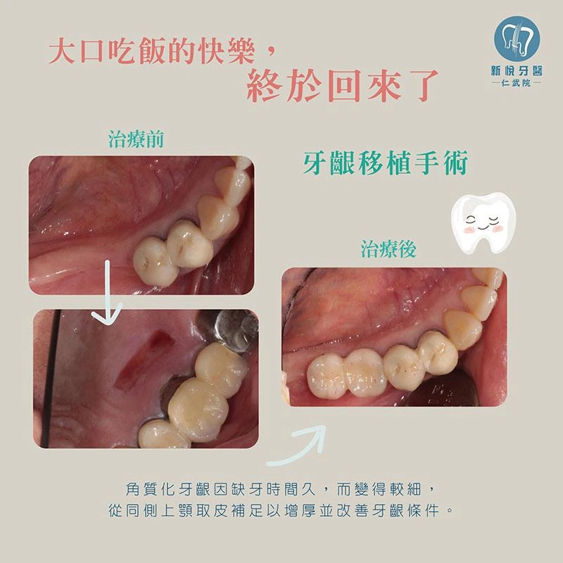 缺牙拖太久,補皮+植牙救回咀嚼力! 缺牙拖太久,補皮+植牙救回咀嚼力!
