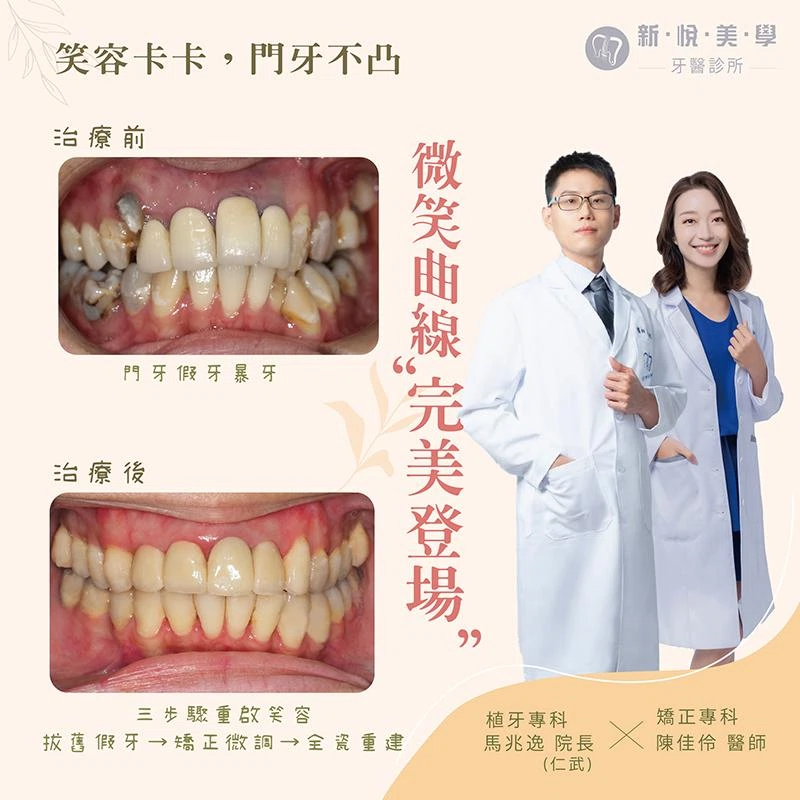 笑容不再卡卡！暴牙假牙改善實例矯正＋全瓷重建