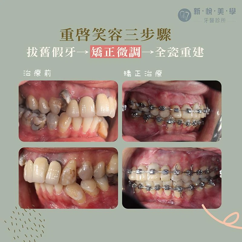 笑容不再卡卡!暴牙假牙改善實例矯正+全瓷重建 笑容不再卡卡!暴牙假牙改善實例矯正+全瓷重建