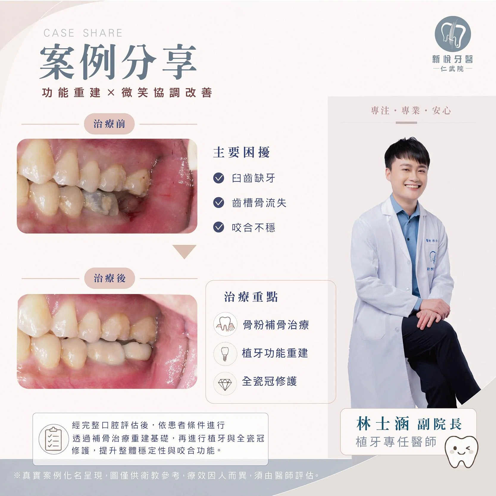 缺牙不補，小心連骨頭一起流失！