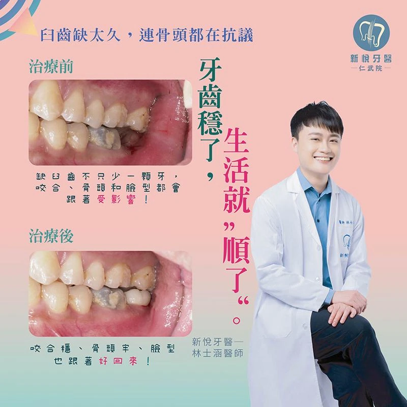 缺牙不補,小心連骨頭一起流失! 缺牙不補,小心連骨頭一起流失!
