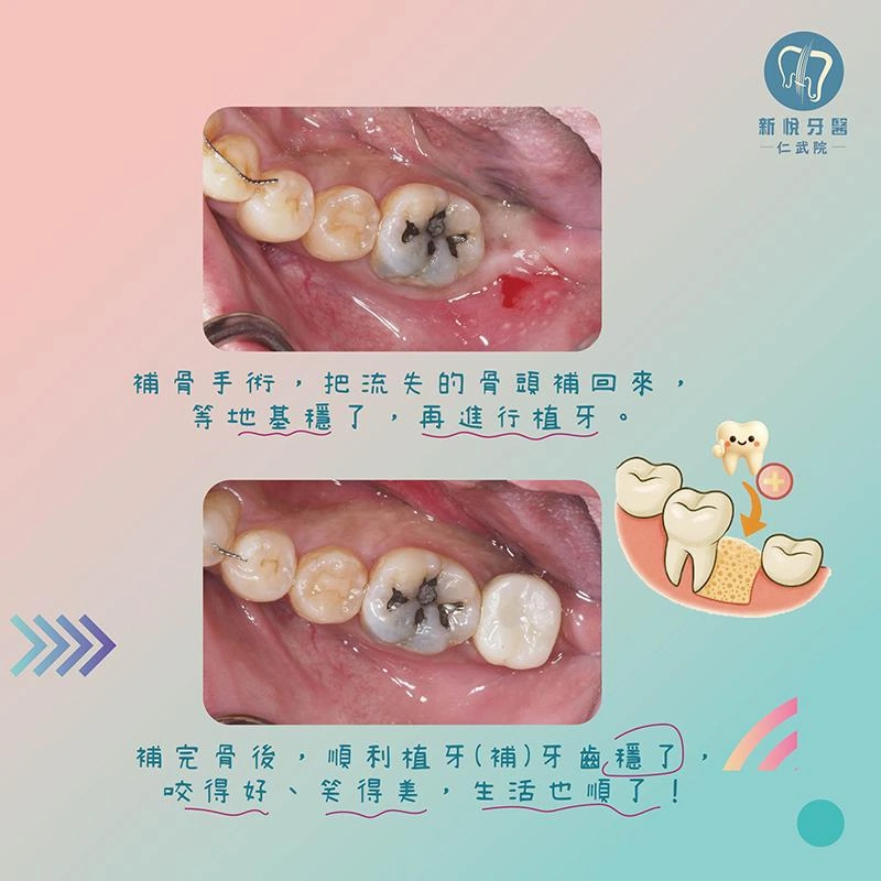 缺牙不補,小心連骨頭一起流失! 缺牙不補,小心連骨頭一起流失!