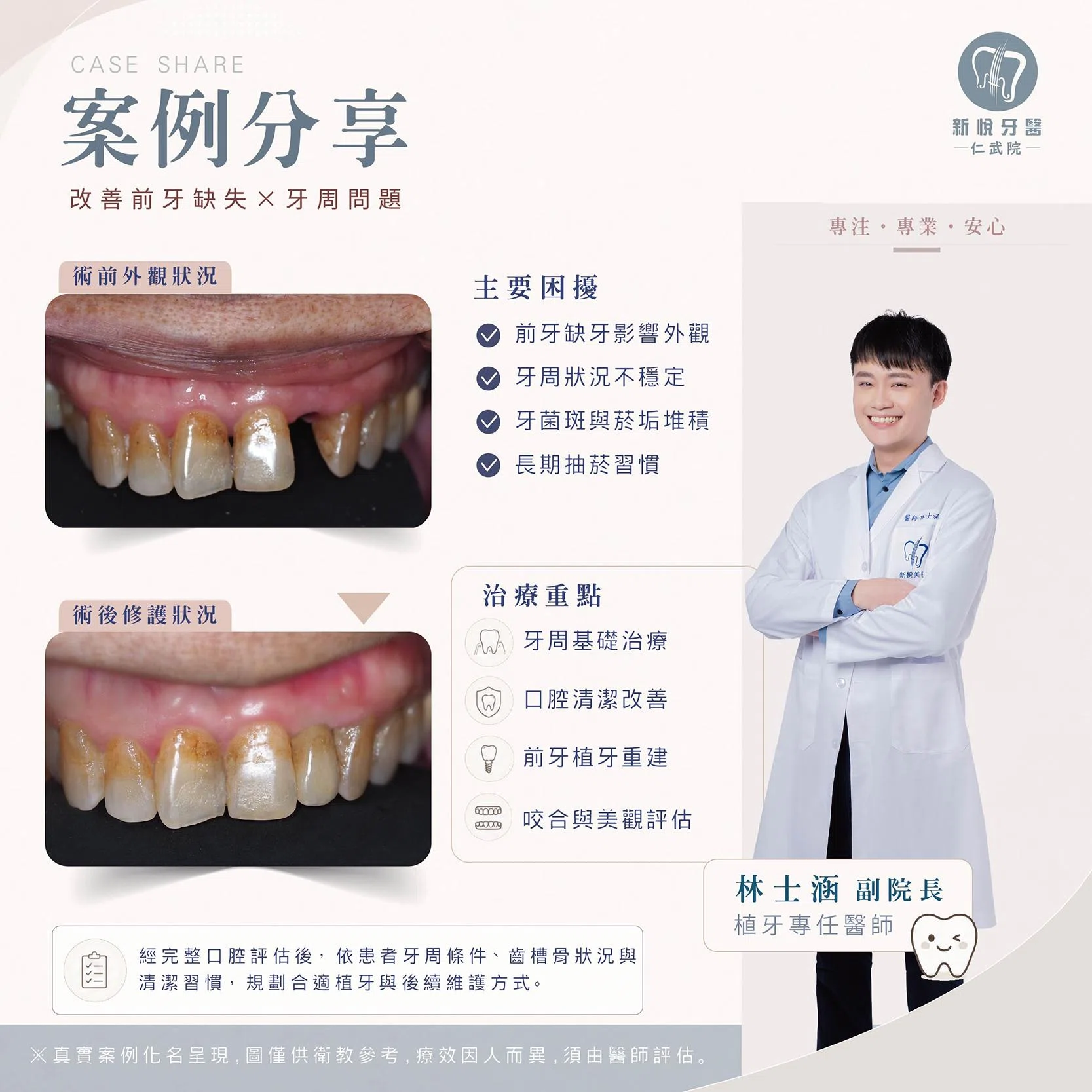 前牙缺牙不只要補牙｜牙周健康與美學修復規劃