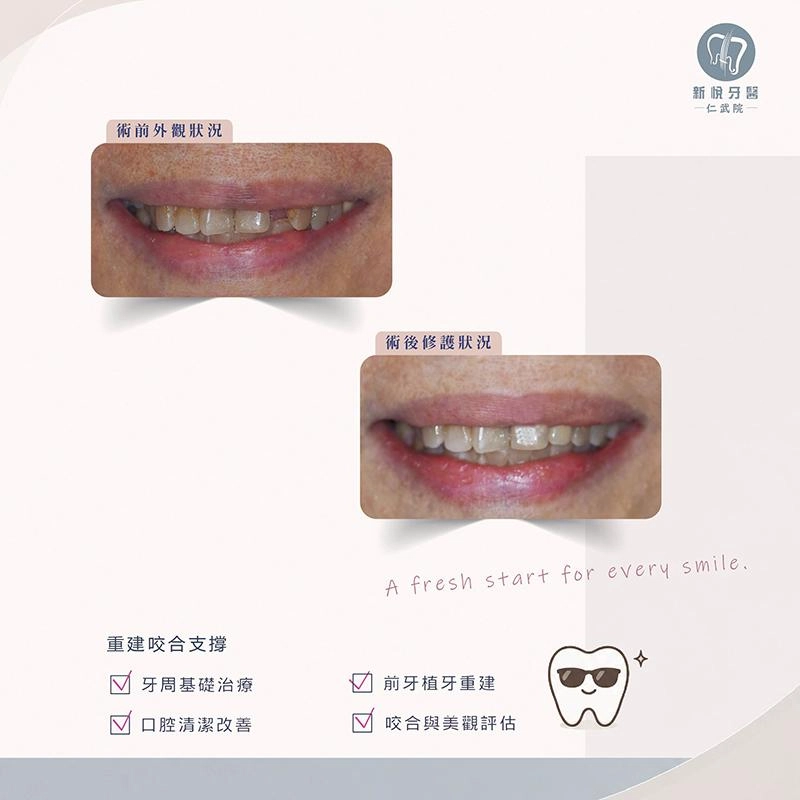 前牙缺牙不只要補牙｜牙周健康與美學修復規劃