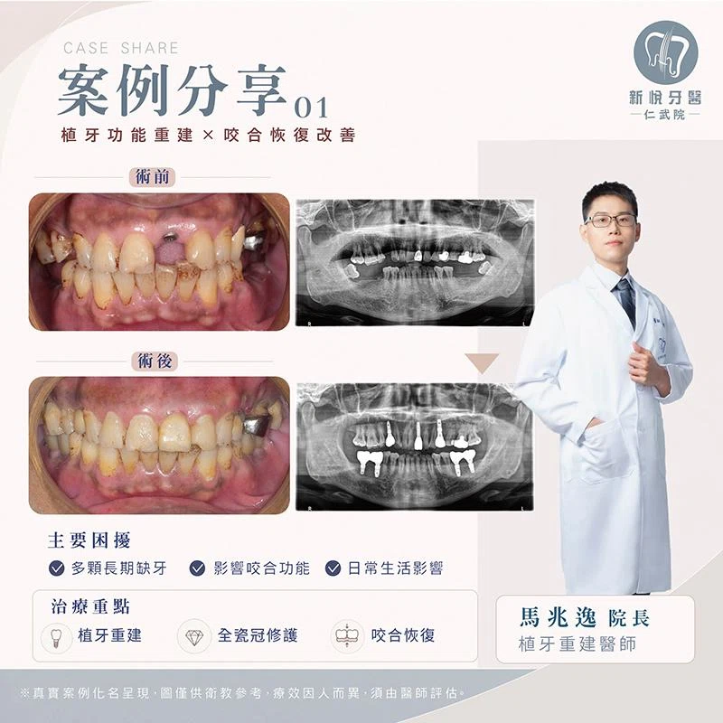 戚先生的「缺牙逆轉術」：7 顆牙齒補回青春