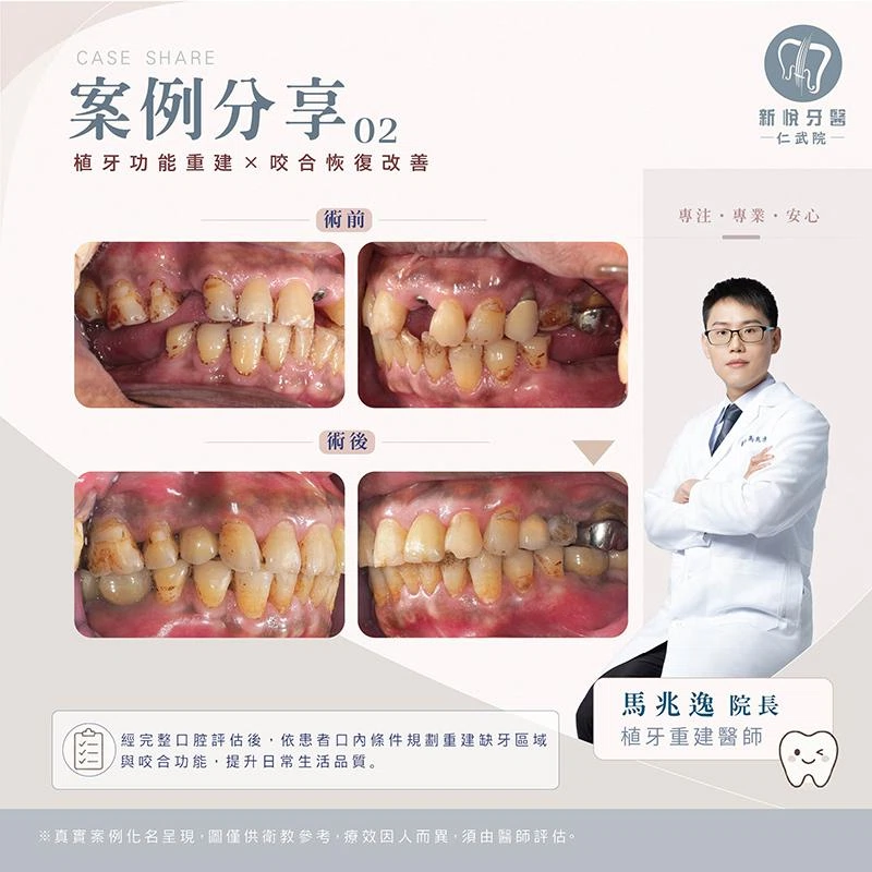戚先生的「缺牙逆轉術」:7 顆牙齒補回青春 戚先生的「缺牙逆轉術」:7 顆牙齒補回青春