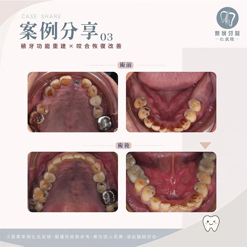 戚先生的「缺牙逆轉術」:7 顆牙齒補回青春 戚先生的「缺牙逆轉術」:7 顆牙齒補回青春
