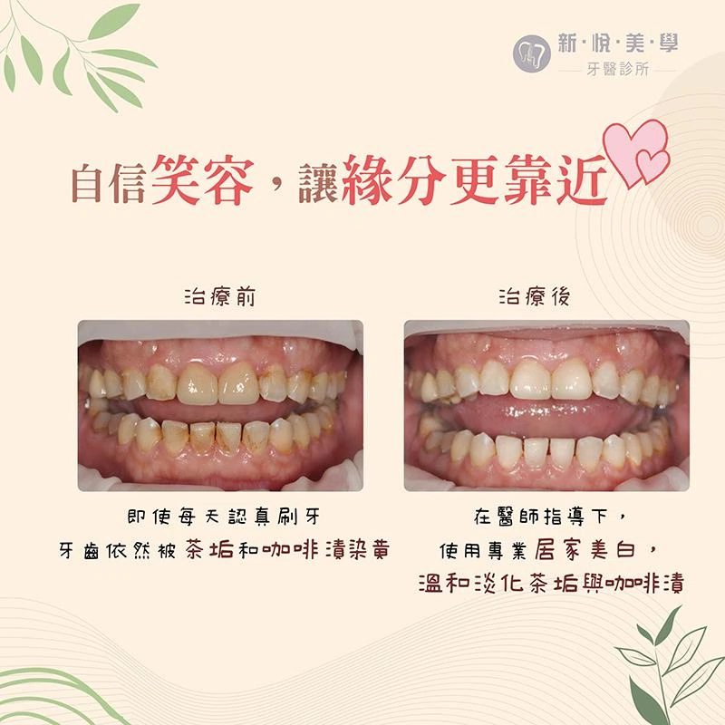 微笑!從齒開始,別讓黃牙擋住你的桃花! 微笑!從齒開始,別讓黃牙擋住你的桃花!