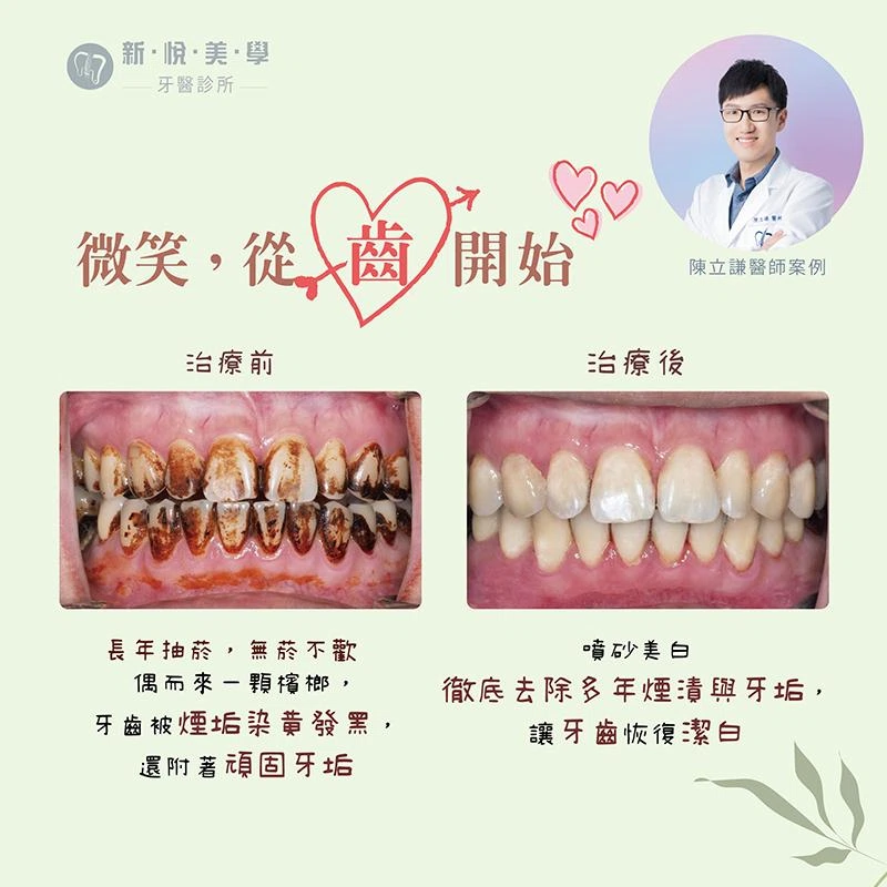 微笑！從齒開始，別讓黃牙擋住你的桃花！