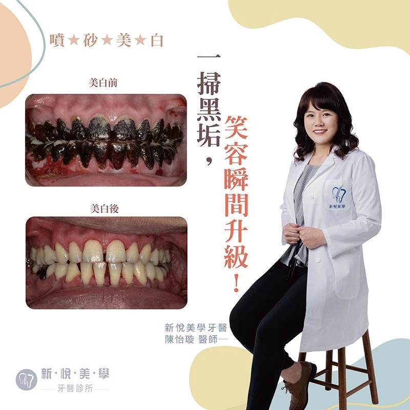 噴砂美白療程 / 牙齒嘿嘿有救了！