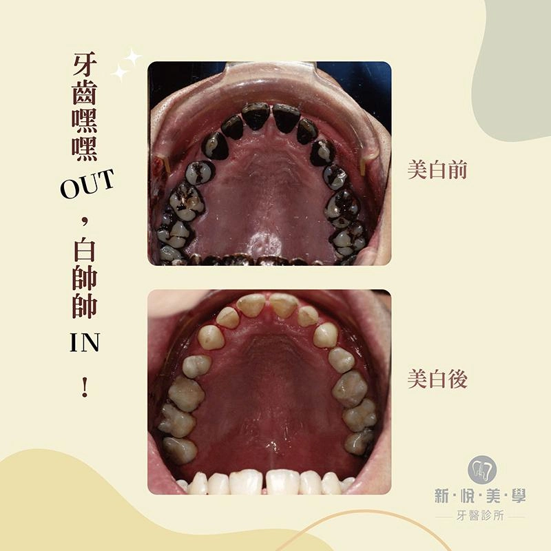 噴砂美白療程 / 牙齒嘿嘿有救了! 噴砂美白療程 / 牙齒嘿嘿有救了!