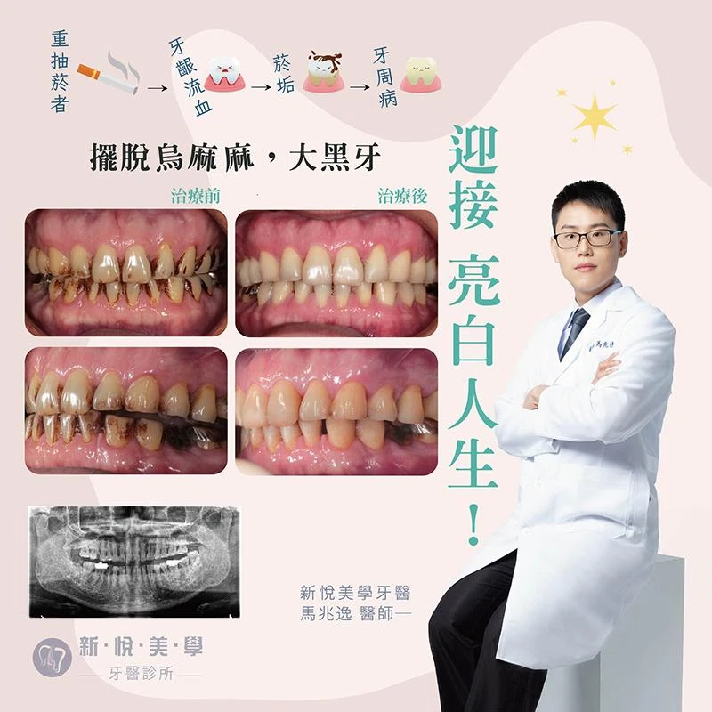 擺脫烏麻麻 大黑牙， 迎接亮白人生！