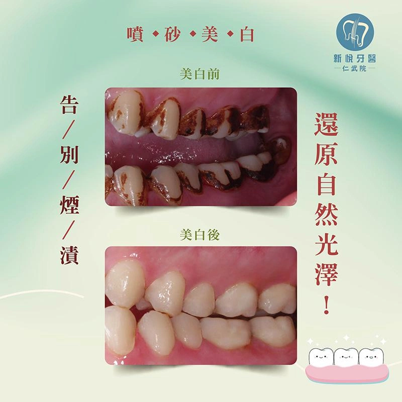 抽菸讓牙齒變黑?名廚阿偉靠「噴砂美白」重拾自信笑容 抽菸讓牙齒變黑?名廚阿偉靠「噴砂美白」重拾自信笑容