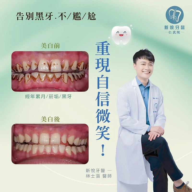抽菸讓牙齒變黑?名廚阿偉靠「噴砂美白」重拾自信笑容 抽菸讓牙齒變黑?名廚阿偉靠「噴砂美白」重拾自信笑容