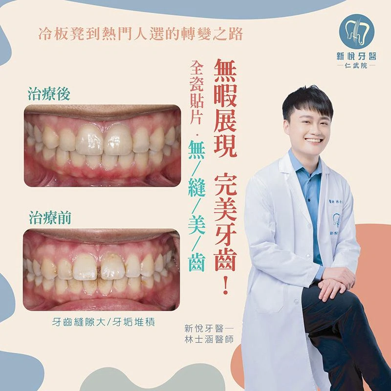 小滿的牙縫困擾全瓷貼片改善牙縫