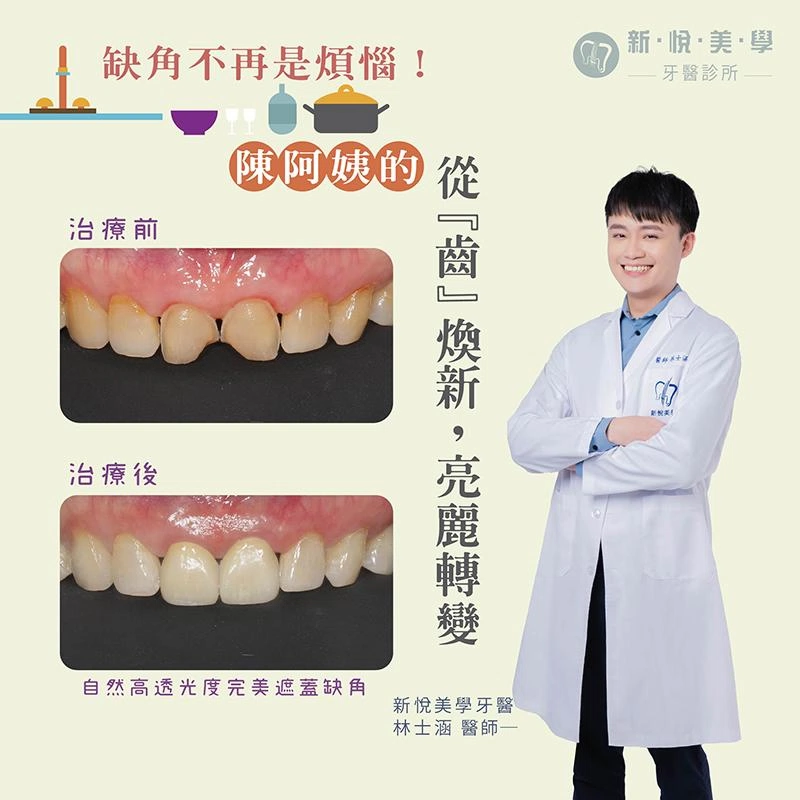 缺角不再是煩惱！廚具女王的美齒奇蹟