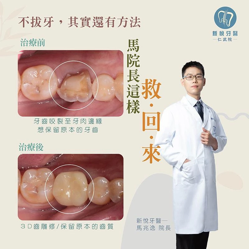 根管治療牙裂後還能留住嗎？3D齒雕修復的另一種選擇