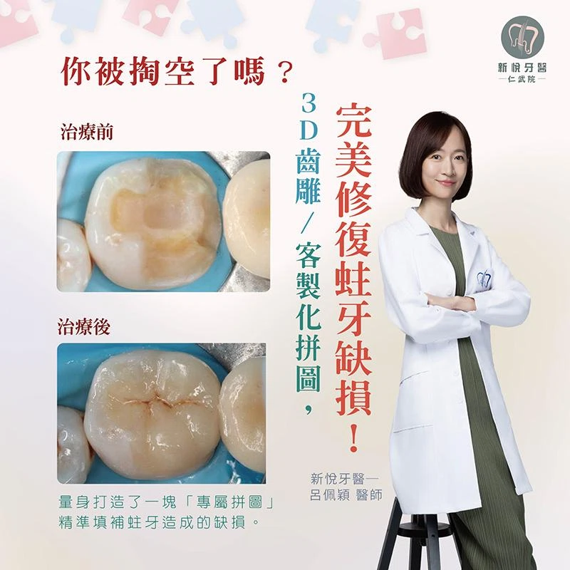 你被掏空了嗎？客製化拼圖，完美修復蛀牙缺損！