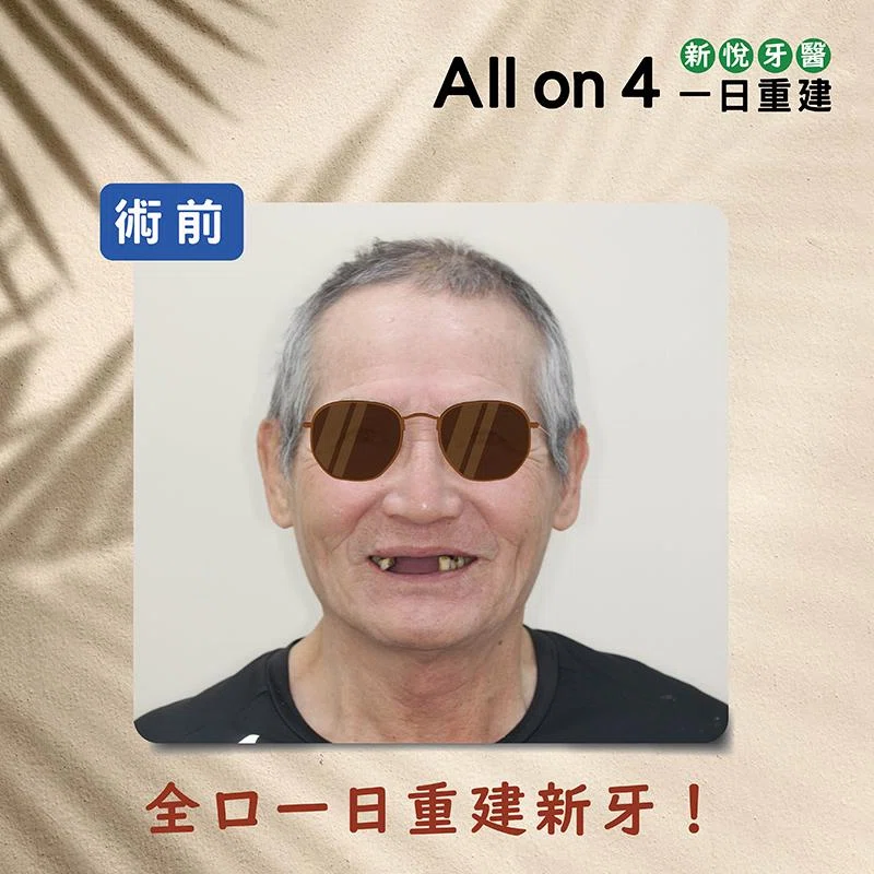 為什麼要做 All on 4 全口重建植牙？