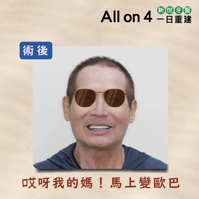 為什麼要做 All on 4 全口重建植牙？