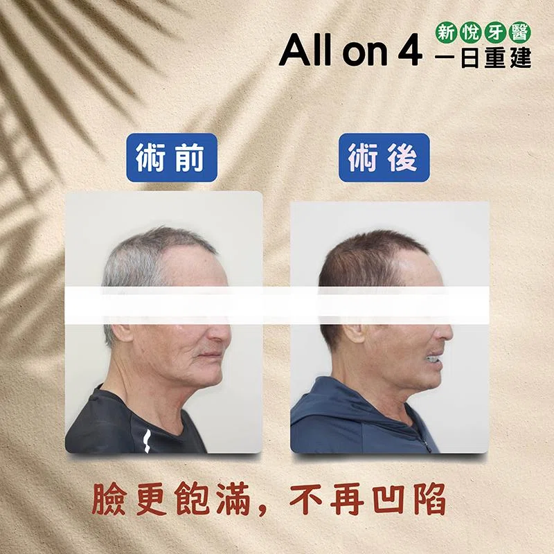 為什麼要做 All on 4 全口重建植牙？