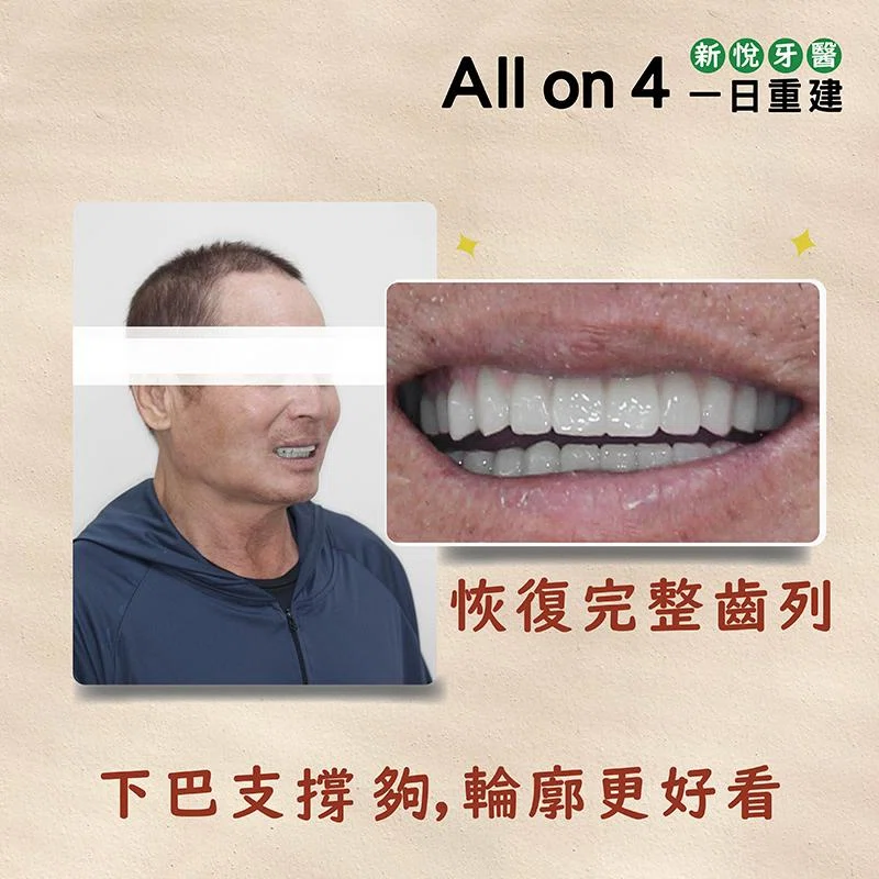 為什麼要做 All on 4 全口重建植牙？
