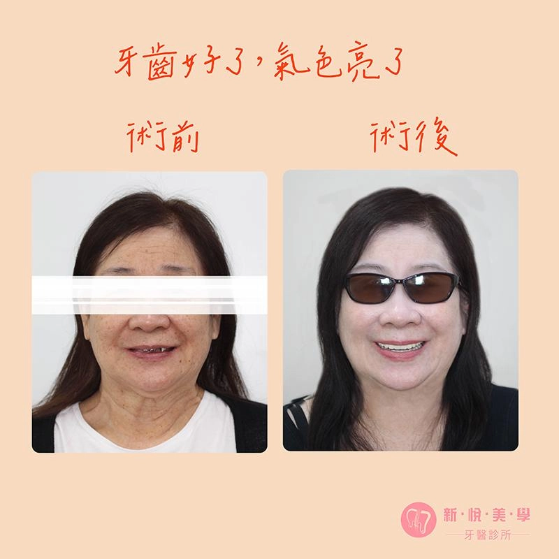 重建一口好牙，讓媽媽從「阿姨」變「姐姐」！