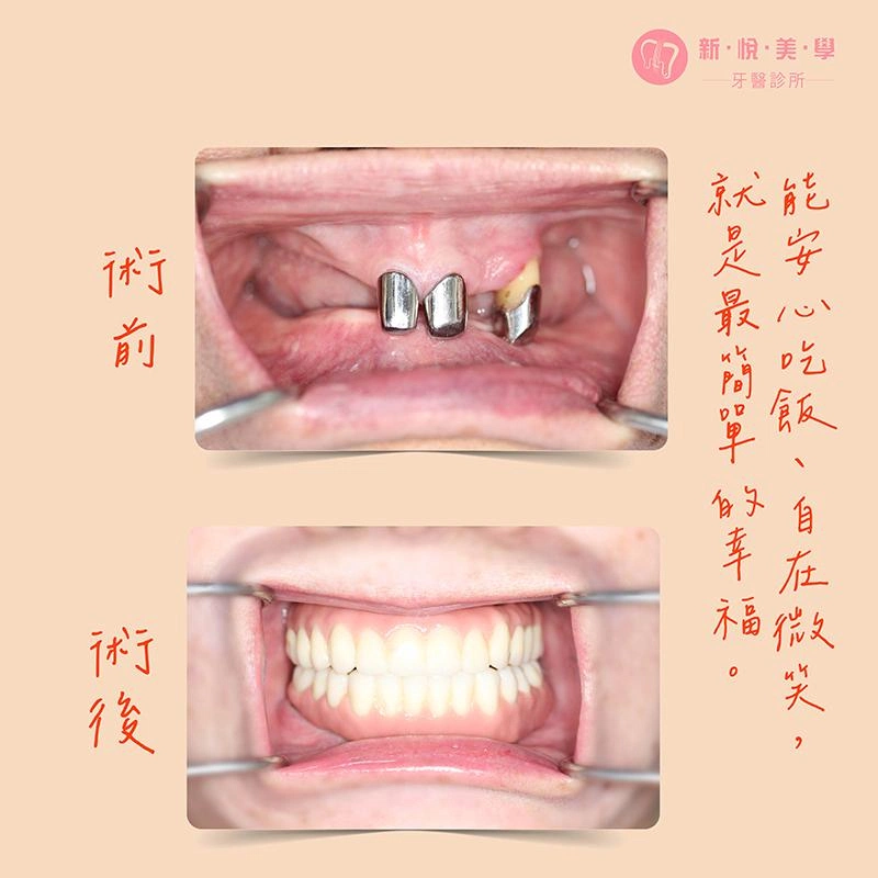 重建一口好牙，讓媽媽從「阿姨」變「姐姐」！