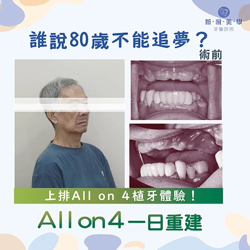 陳伯伯80歲重拾美食人生：植牙讓他笑得更年輕！