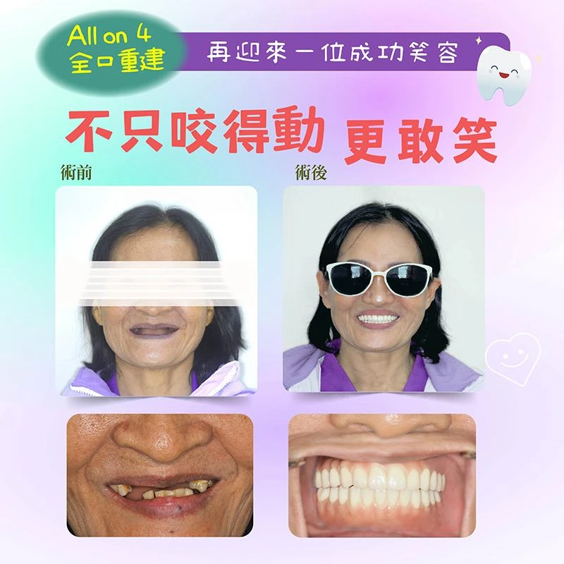 笑容消失的真相:不是變老,是牙齒撐不住了 笑容消失的真相:不是變老,是牙齒撐不住了