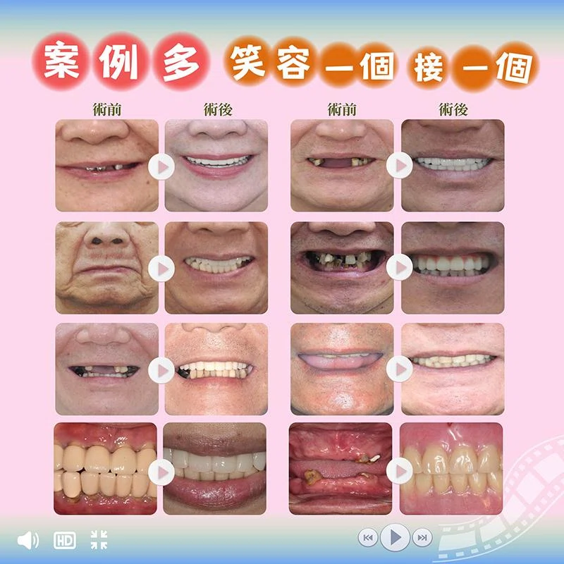 笑容消失的真相:不是變老,是牙齒撐不住了 笑容消失的真相:不是變老,是牙齒撐不住了