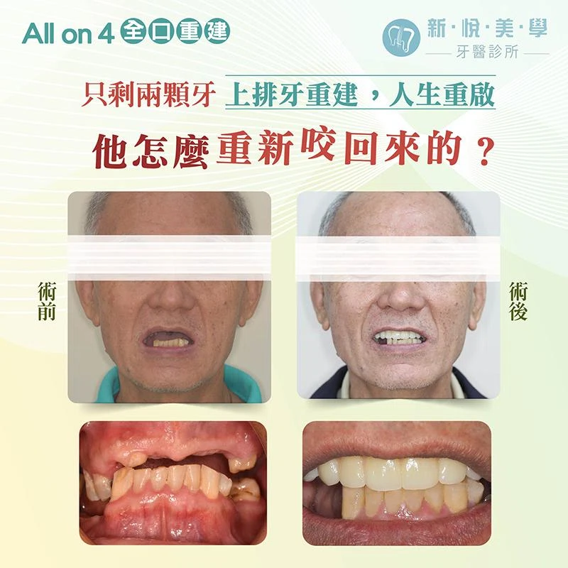 上排只剩二顆牙，還有救嗎？上顎全口重建完整解析