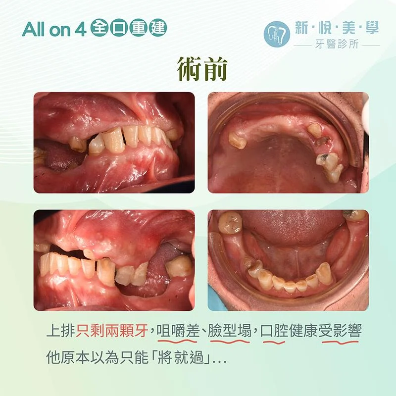 上排只剩二顆牙，還有救嗎？上顎全口重建完整解析