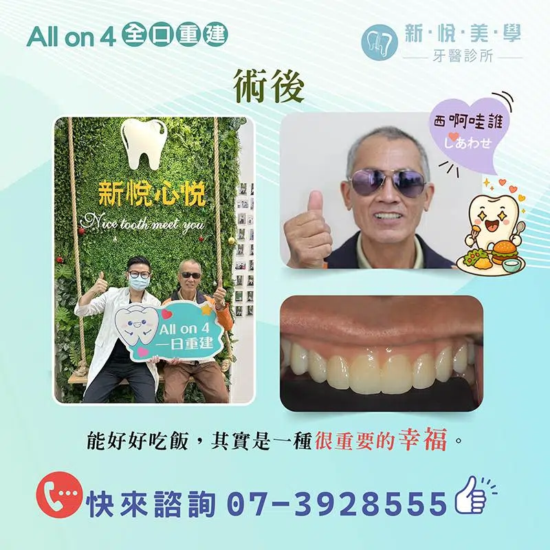 上排只剩二顆牙，還有救嗎？上顎全口重建完整解析