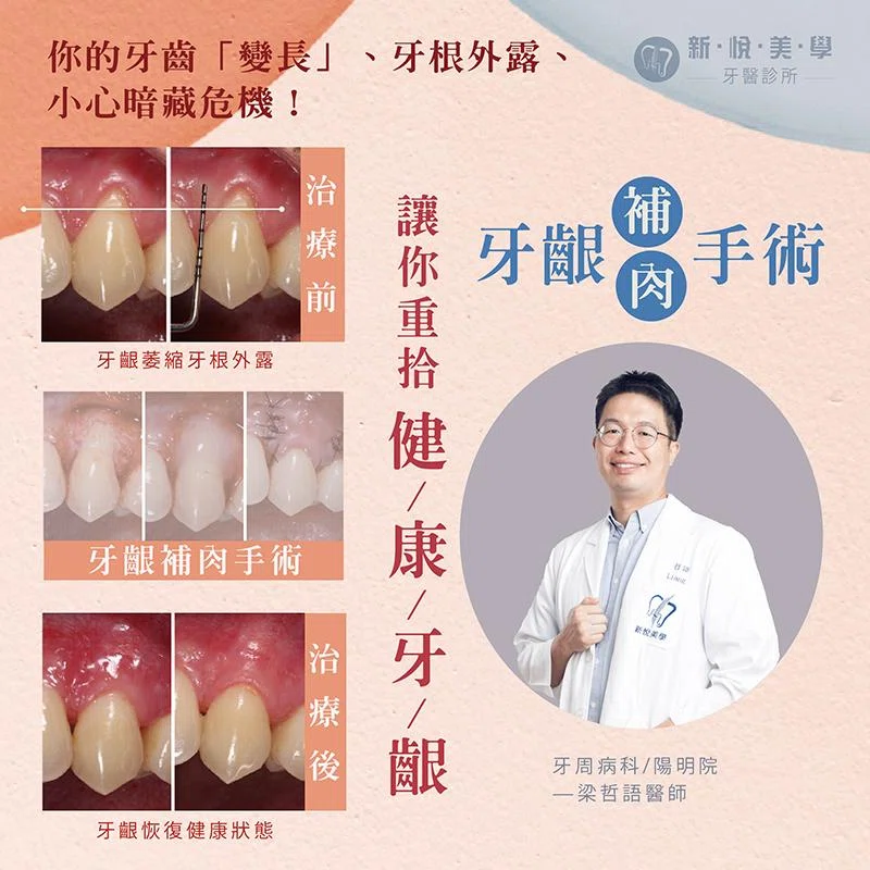 牙齒「變長」了？小心牙齦萎縮與牙周病正在悄悄找上門！