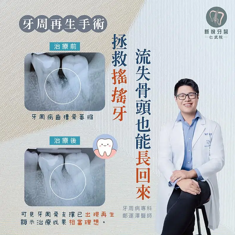 牙齒在晃，不一定要拔，牙周再生手術保住牙齒