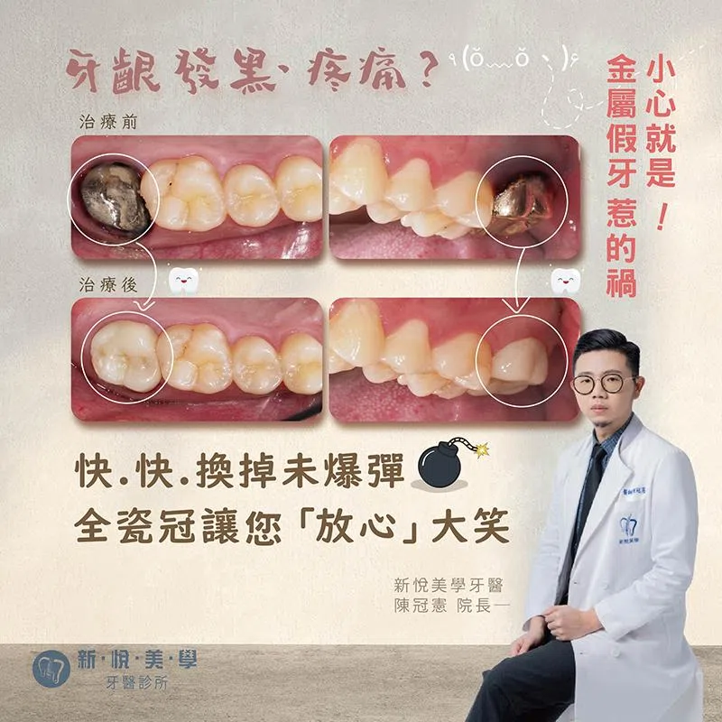 牙齦發黑、疼痛？ 小心就是 金屬假牙惹的禍！