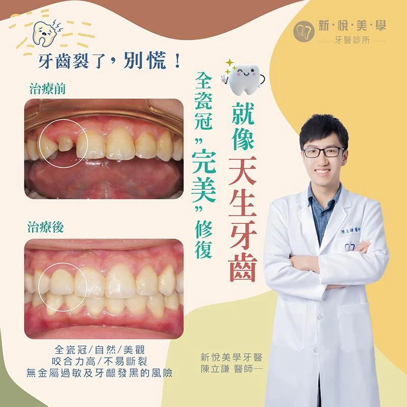 牙齒裂了別慌！全瓷冠修復讓微笑重現