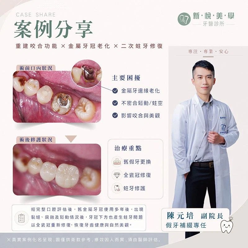 金屬牙套鬆動怎麼辦？牙套不密合可能增加二次蛀牙與牙裂風險