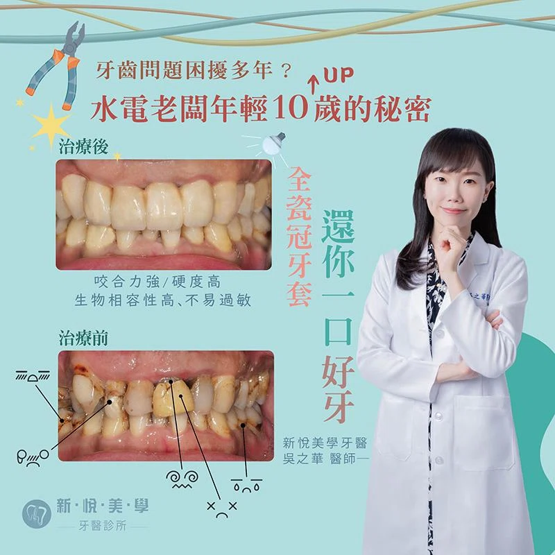 全瓷牙套，還你一口好牙，解決多年困擾