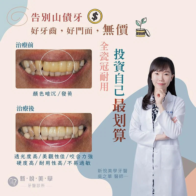 告別山債牙，全瓷冠耐用，投資自己最划算