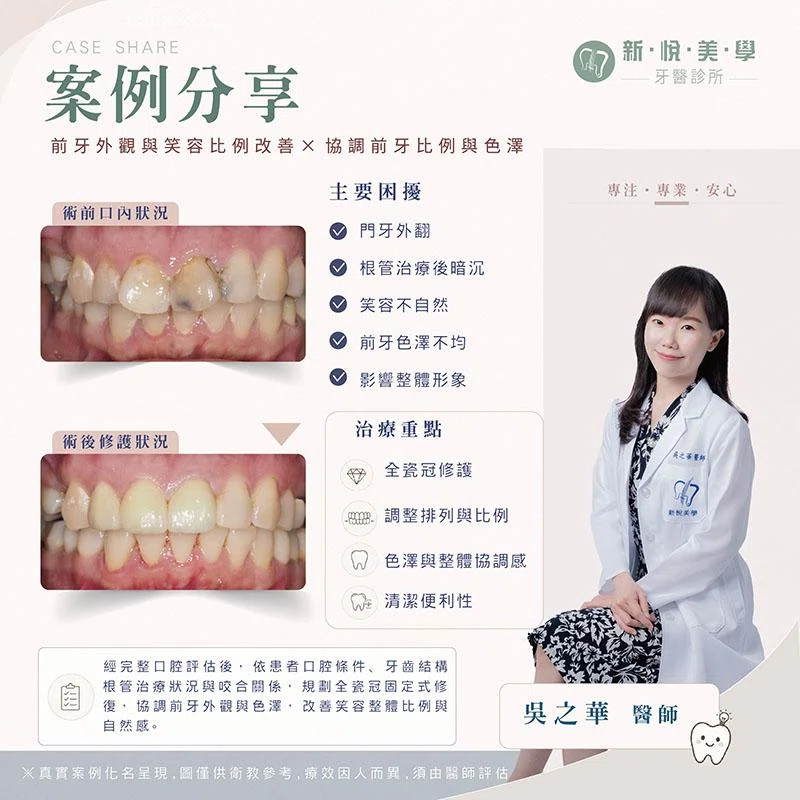 前牙外翻與牙齒暗沉改善：全瓷冠修復評估