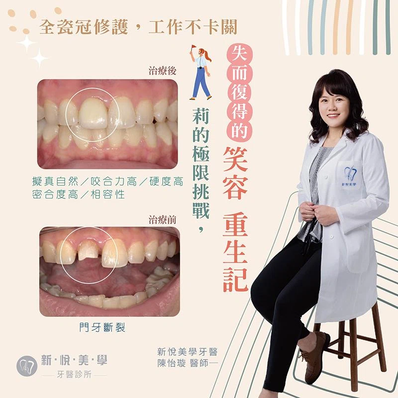 挑戰極限卻斷牙？莉的全瓷冠修復之路