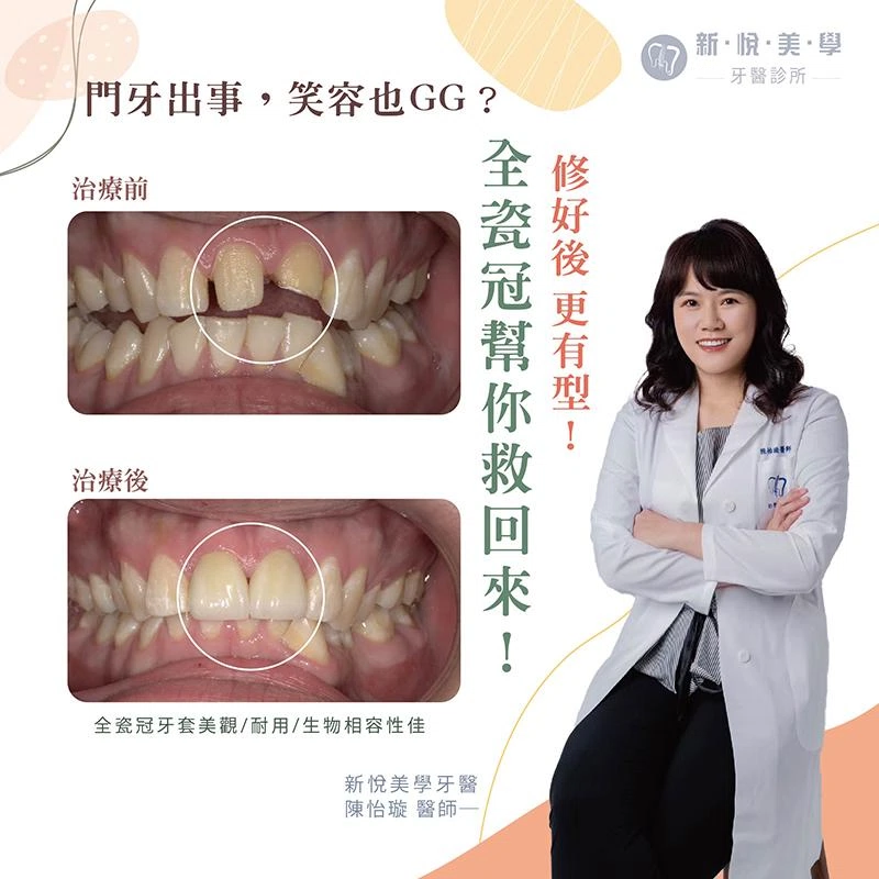 門牙出事，笑容也GG？全瓷冠幫你救回來！